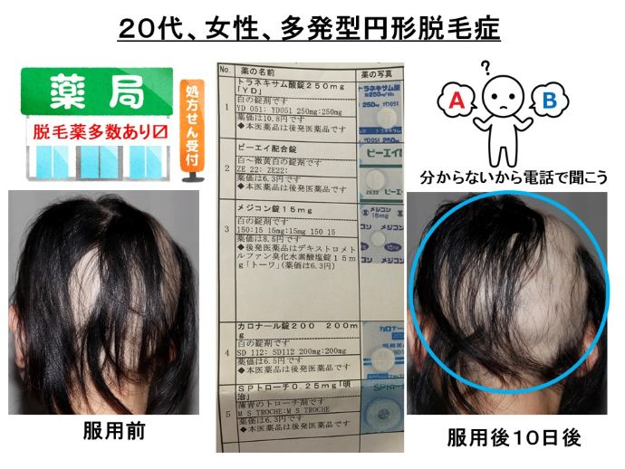 円形脱毛症　病院